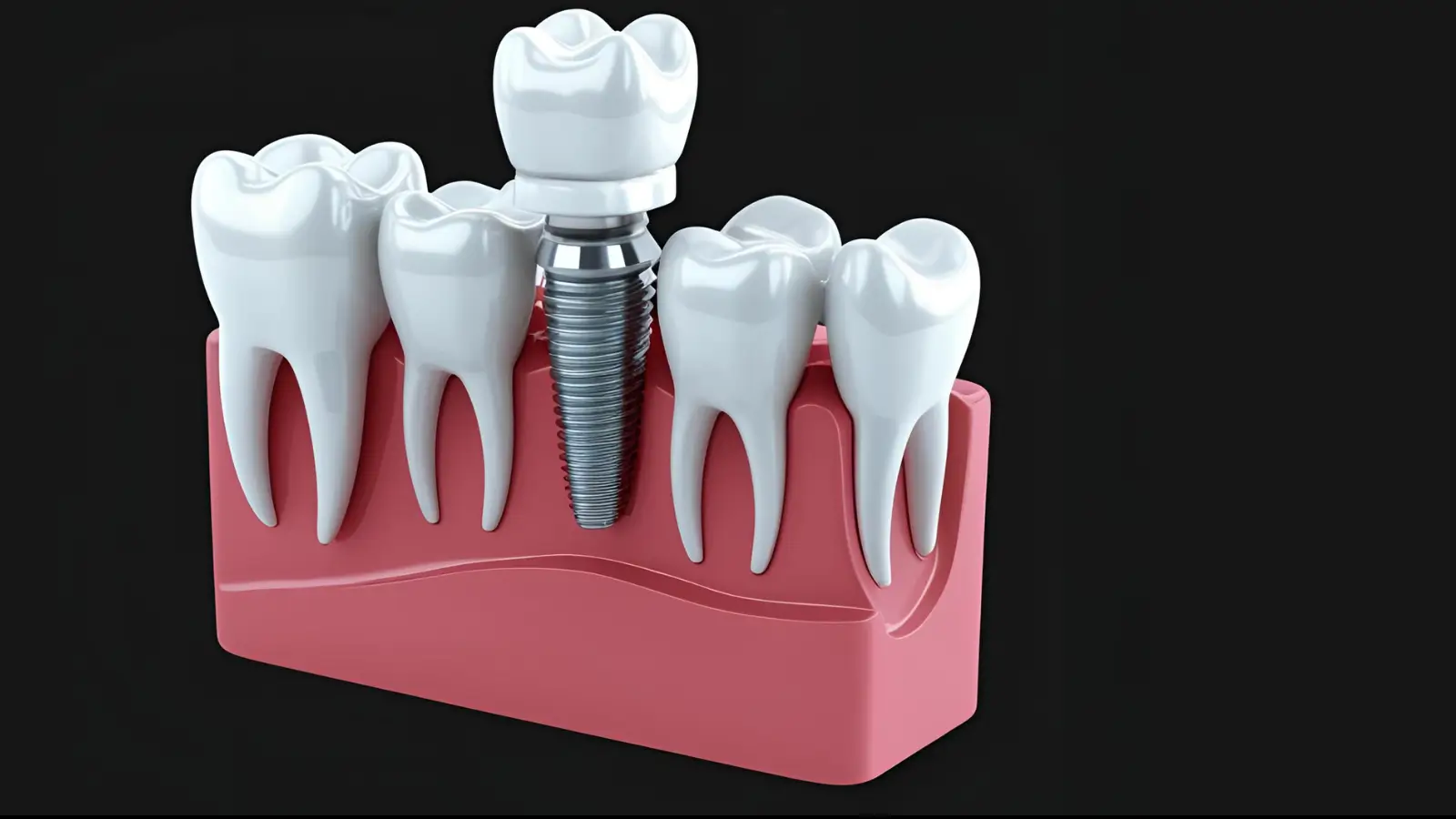 Dental Implant Longevity