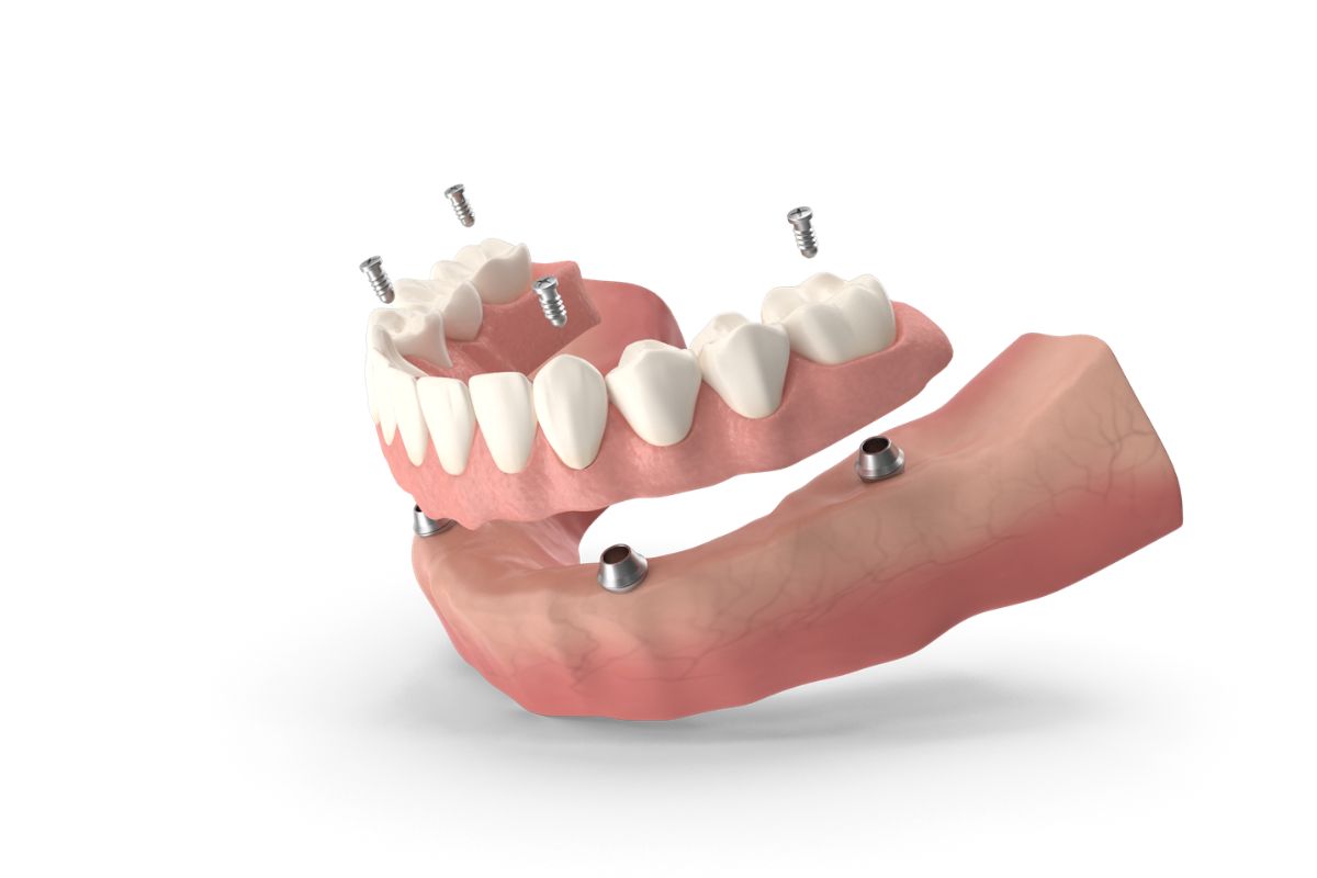 Dental Implants Bellevue